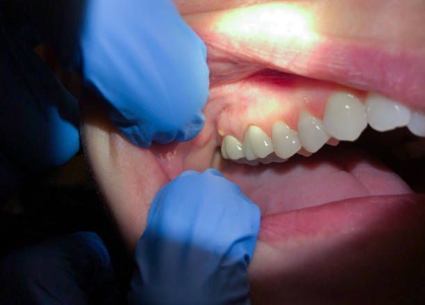 Best Emergency Wisdom Tooth Extraction in Ivanhoe, TX